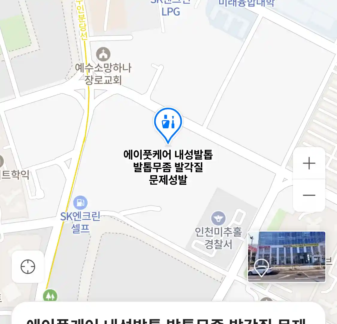 에이풋케어 내성발톱 발톱무좀 발각질 문제성발 위치